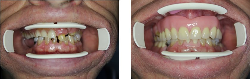Aspen Dental Comfilytes Dentures Nimitz WV 25978